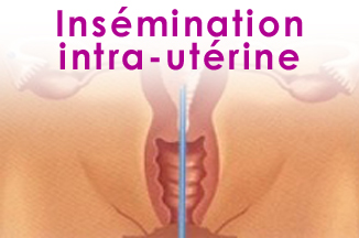 Insemination intra-uterine